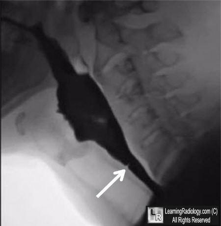 cervical esophageal web